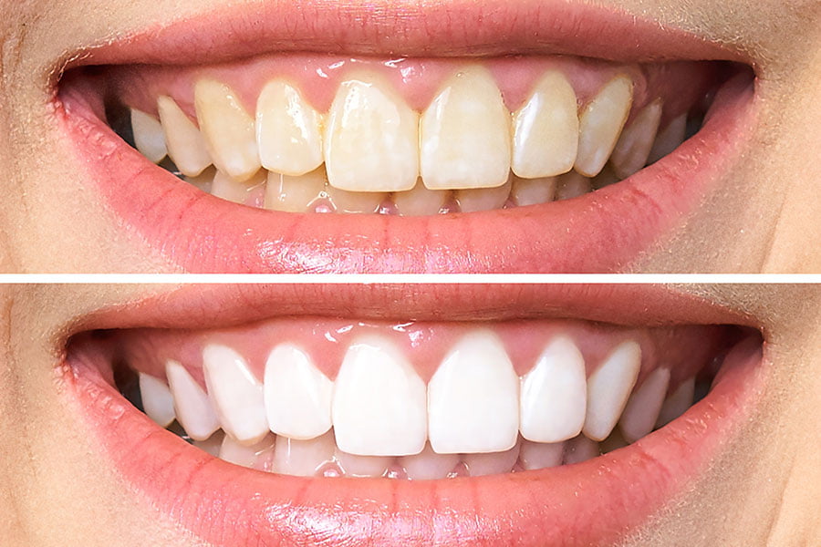 en qué consiste el blanqueamiento dental