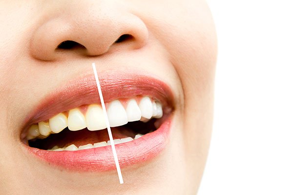 efectos blanqueamiento dental