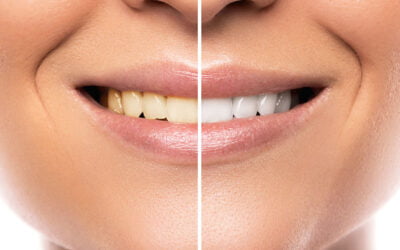 ¿Qué es y en qué consiste el blanqueamiento dental?