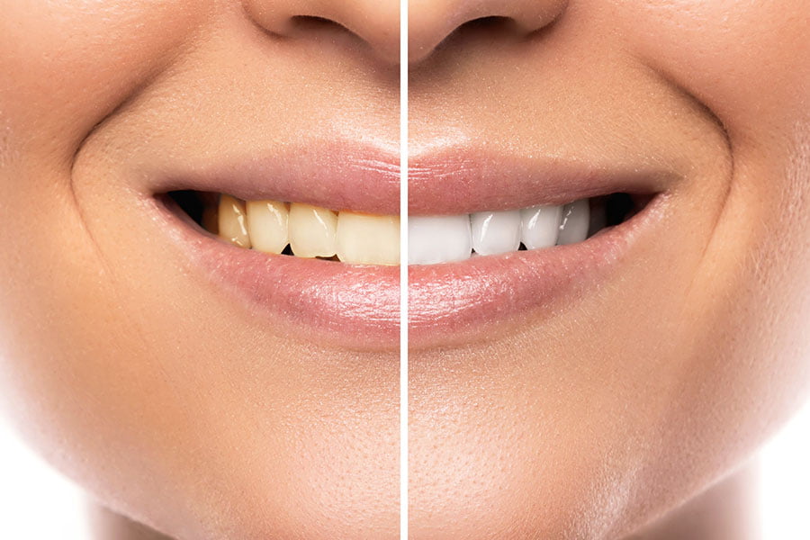 ¿Qué es y en qué consiste el blanqueamiento dental?