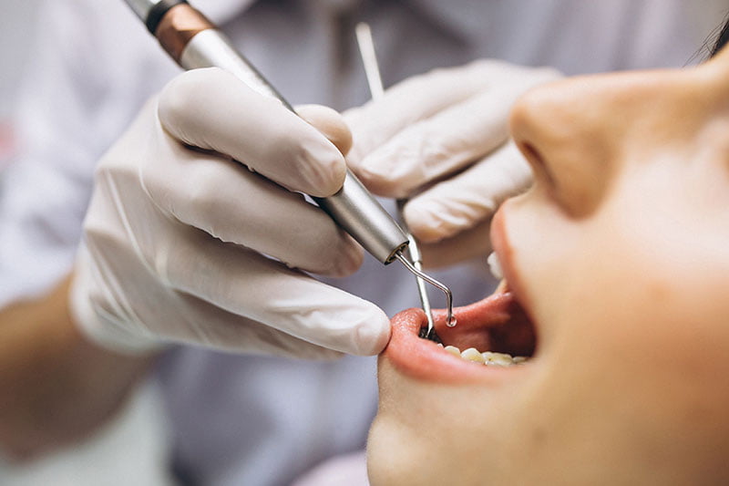 pérdida de hueso dental | Clínica Dental Parque