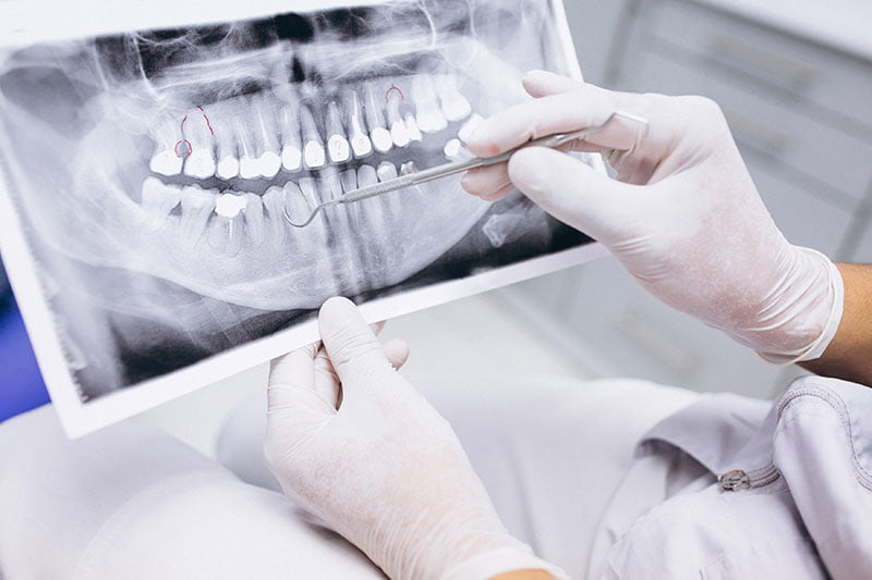 Te lo contamos todo sobre la pérdida de hueso dental