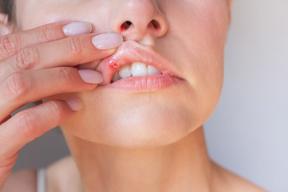 llagas por estomatitis | Clínica Dental Parque