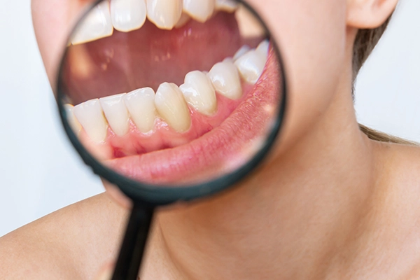 Mucho sarro en los dientes | Clínica Dental Parque