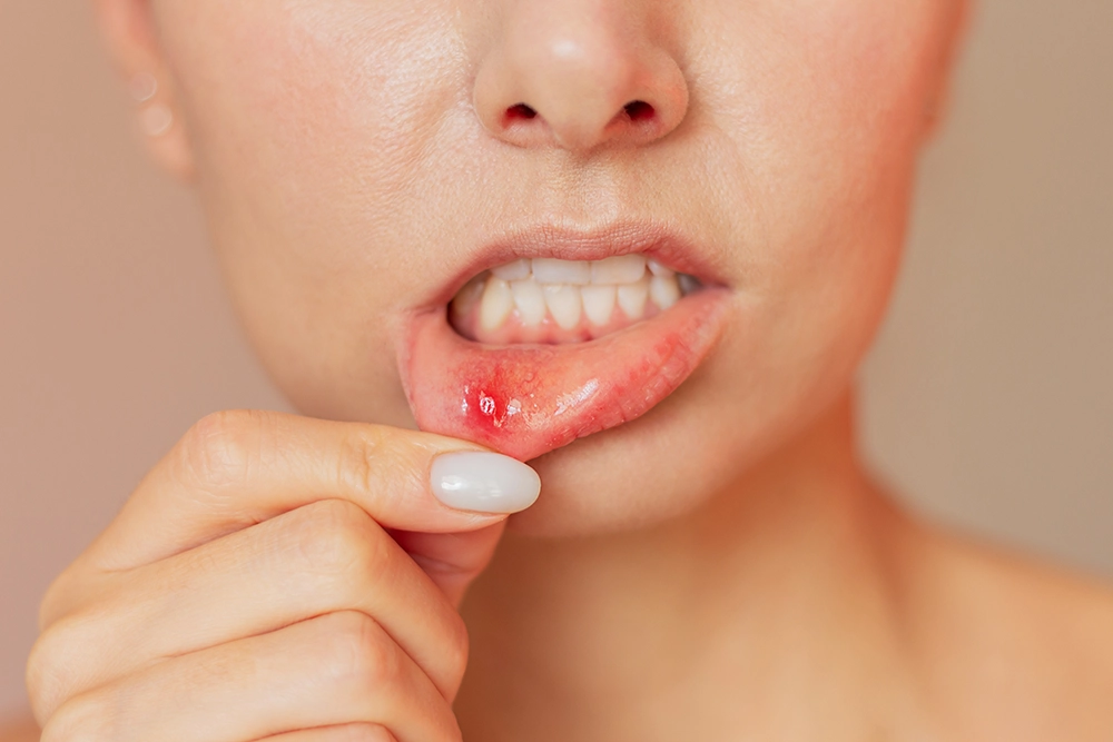 problemas boca estomatitis