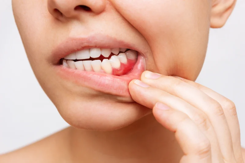 dentista gingivectomía