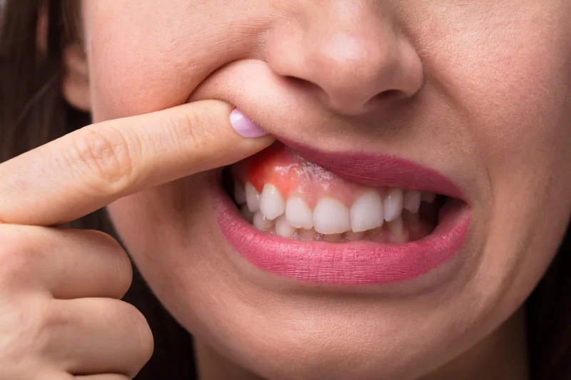 gingivectomía dolor