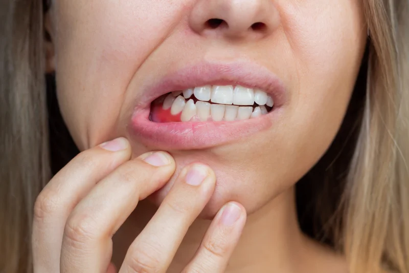 que es la gingivectomía