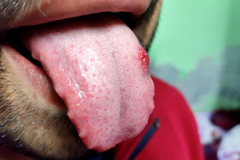 candidiasis oral lengua