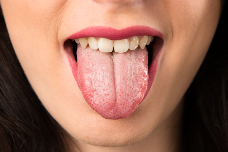 curar hongos en la lengua
