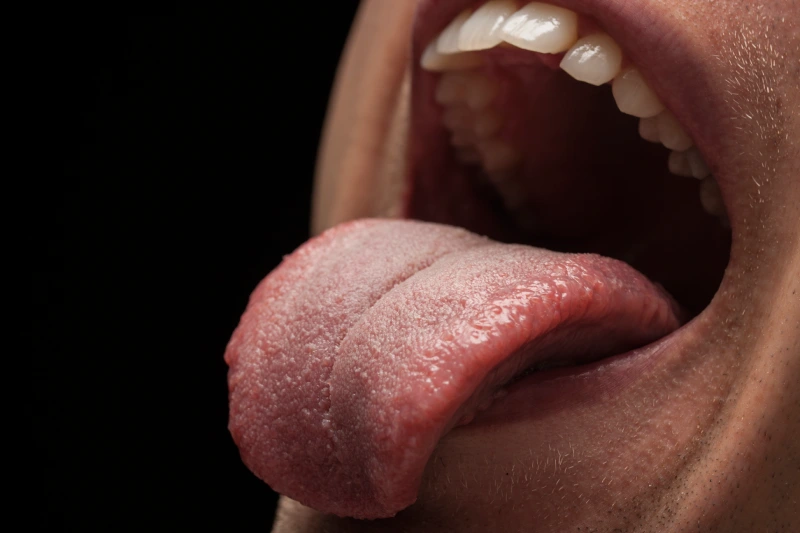 hongos lengua molestias