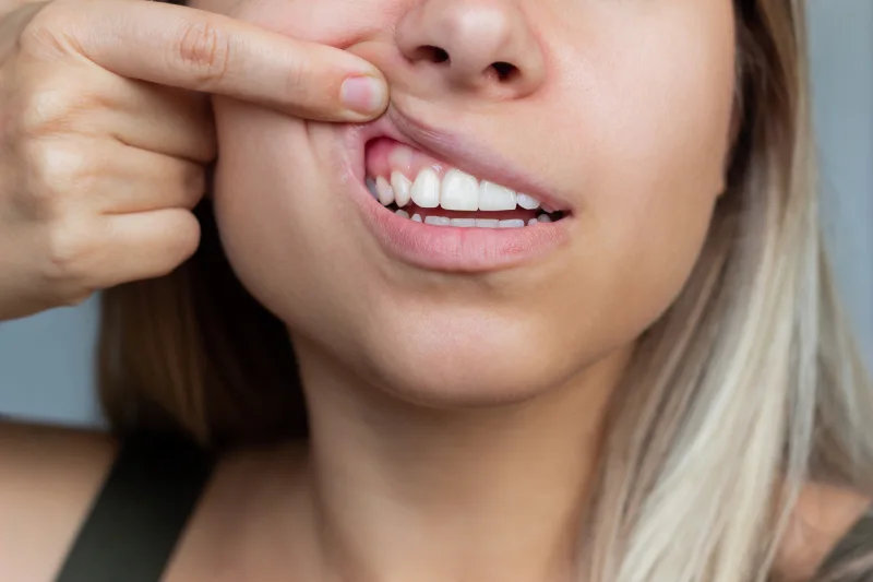 sabes que es la sonrisa gingival